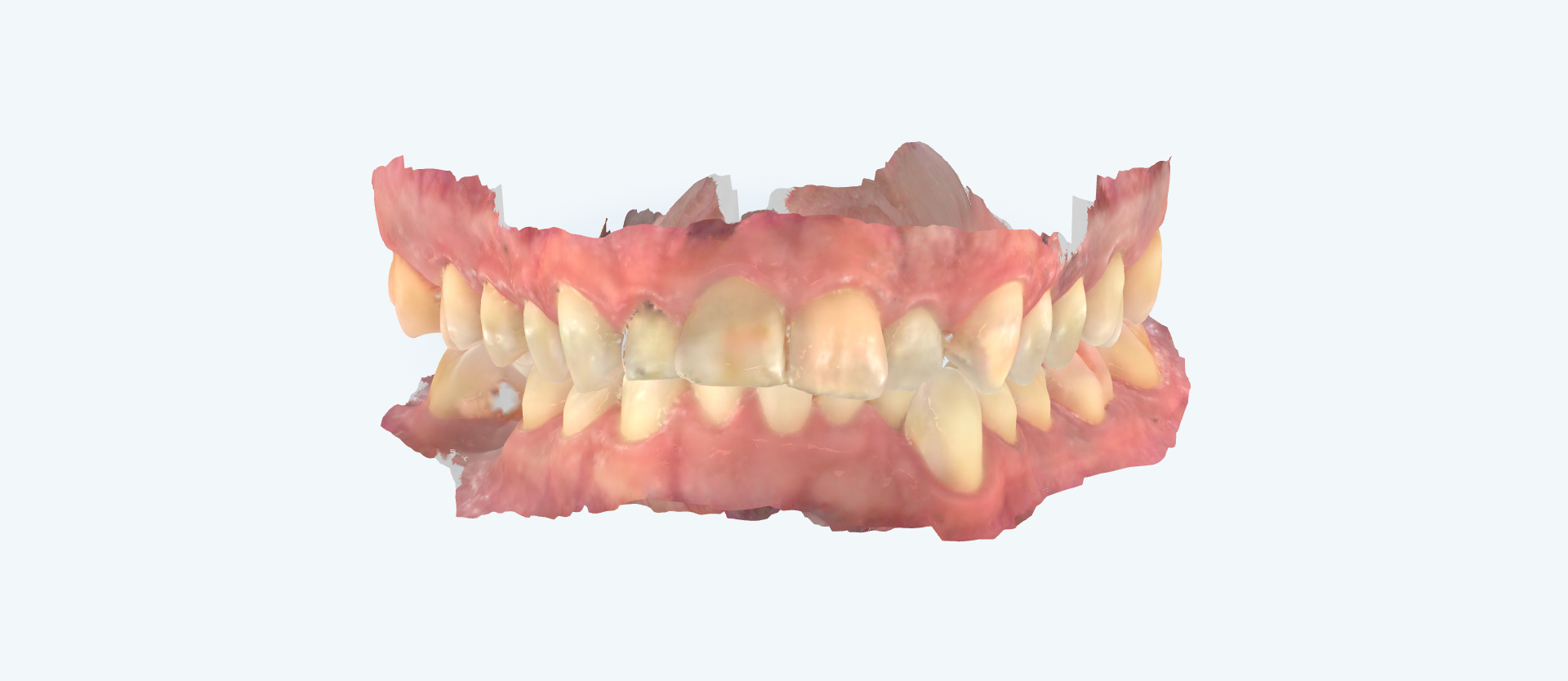 Overbite treatment comparison case 1 before